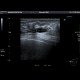 Breast cyst: US - Ultrasound